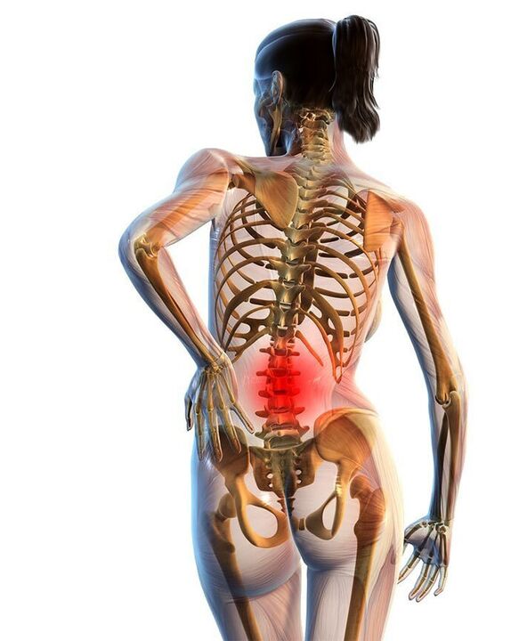 Cel mai des apare osteocondroza coloanei lombare