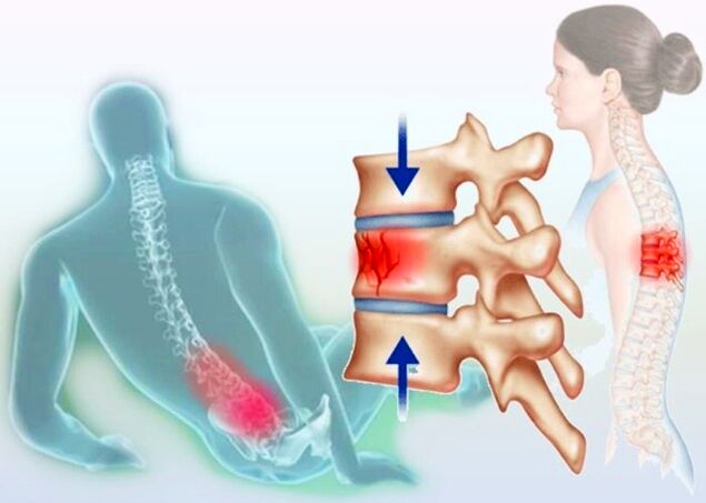 Chiar și o leziune obișnuită poate declanșa dezvoltarea osteocondrozei