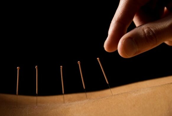 Acupunctura vă va ajuta să scăpați de durerile de spate